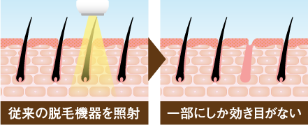従来の脱毛機器を照射 一部にしか効き目がない