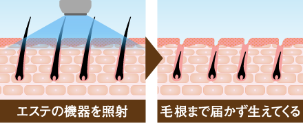 エステの機器を照射 毛根まで届かず生えてくる