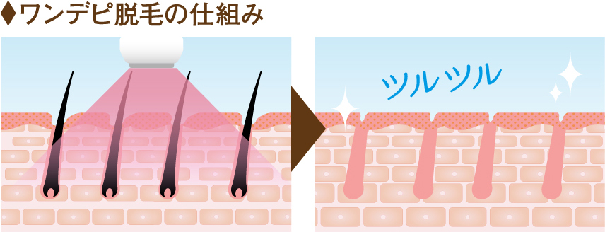 ワンデピ脱毛の仕組み