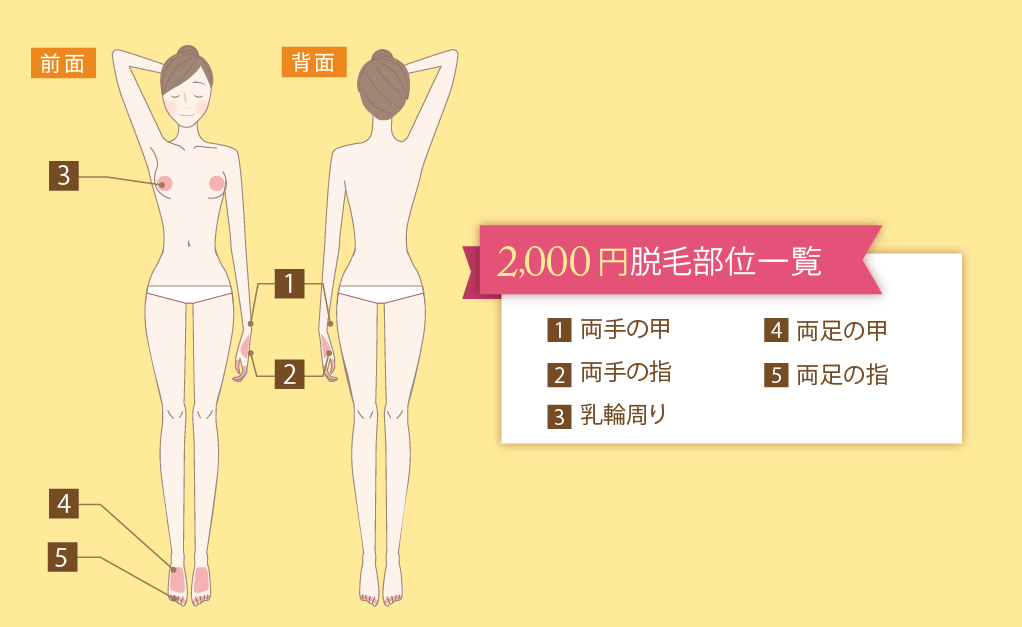 2,000円プラン脱毛部位一覧