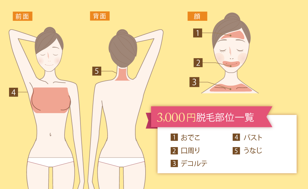 3,000円プラン脱毛部位一覧